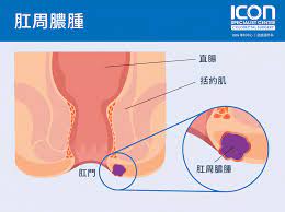 肛周膿腫— ICON專科中心
