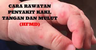 Ish, nak kena cari maklumat ni. Cara Rawatan Semulajadi Penyakit Kaki Tangan Dan Mulut Atau Hfmd
