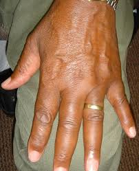 Image result for Dactylitis