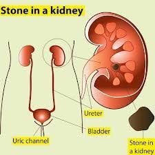 Tips To Pass A Kidney Stone Naturally Herbal Treatment Kidney Stones Remedy Herbalism