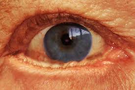 Image result for Entropion