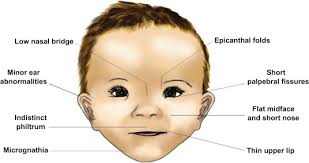 And/or a small jaw (micrognathia) and small mouth with protruding lips. Language Lateralization In Fetal Alcohol Spectrum Disorders Sciencedirect