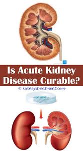 Pin On Kidney Disease
