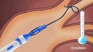 Einfach Erklart Katheterablation Zur Behandlung Von Herzrhythmusstorungen Youtube