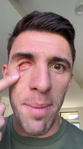 Wearing my real eye 😳