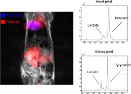 Apr 19, 2021 can garlic lower blood pressure? 13 C Chemical Shift Image Reporting Pyruvate And Lactate Distribution Download Scientific Diagram