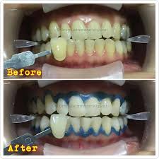 Cari info harga putihkan gigi murah di patuk ???? Harga Putihkan Gigi Di Klinik Kerajaan