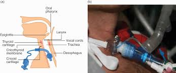 The Patient With A Tracheostomy Chapter 29 Core Topics In Airway Management