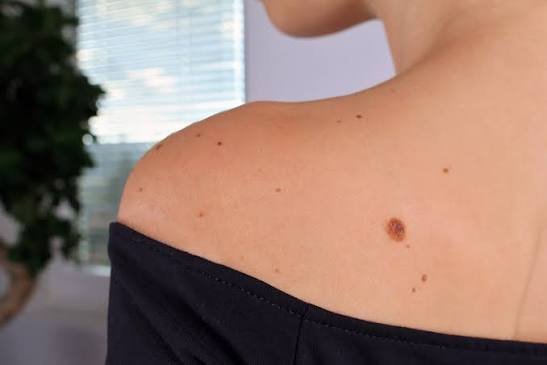 3 Types of Skin Moles & When to Worry
