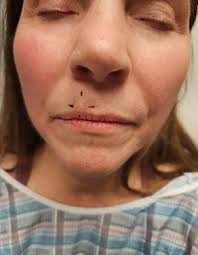 Mohs Surgery: A Precise Approach to Treating Skin Cancer