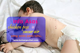 The varivax vaccine is 95% effective against chickenpox. Chicken Pox Atau Cacar Air Keluarga Sihat Dot Com