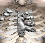 Applications of Titanium Alloy 3D Printing Technology ...