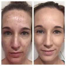 My Friend Used Arbonne Clear Future And Genius Microdermabrasion Wipes For 2 Months With These Amazing Results As Microdermabrasion Skin Tags On Face Arbonne