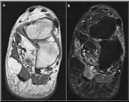 Plantar fasciitis is an extremely painful condition, and it is also difficult to treat for a variety of reasons. Epos Trade