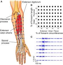 electrode placement forearm related keywords suggestions