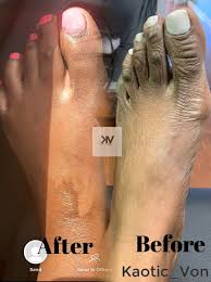Corn Blast Remover Was Created For All Ethnicities Who Are Embarrassed Of Corn S And Calluses We Created The P Discoloration Cream Feet Care Pedicure Designs