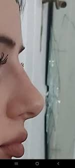 So unterschiedlich sie auch aussehen mögen, ihnen allen kommt eine herausragende rolle zu: Nasenkorrektur Vorher Und Nachher Style Schonheit Gesicht