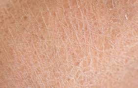 Image result for Ichthyosis