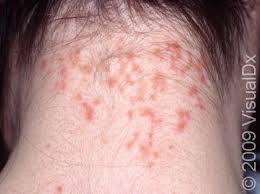 Image result for white scabs on the head in children