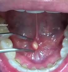 Image result for Sialolithiasis