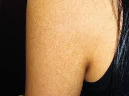 Image result for Keratosis pilaris