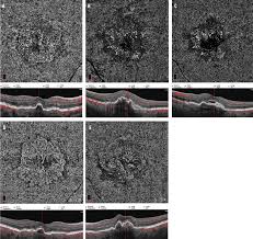 The findings will assist octa in its mission to develop an integrated and balanced transportation system that supports the diverse. Octa Pearls And Pitfalls Retina Today