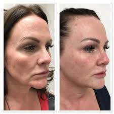 We would like to show you a description here but the site won’t allow us. Reyna S Aesthetic Laser Clinic And Salon 41 Photos 16 Reviews Laser Hair Removal 5455 W 38th Ave Wheat Ridge Co Phone Number Yelp