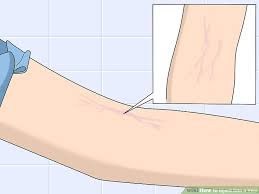How To Inject Into A Vein With Pictures Wikihow