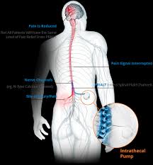Image result for Intrathecal Pump