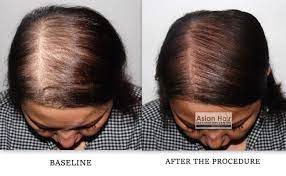 Pin On Female Hair Transplant In Turkey
