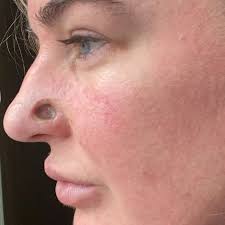 Image result for skin cancer on nose pimple