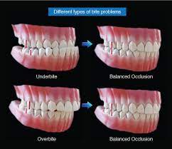 Dental Occlusion Anterior Guidance Part 2 Should I Be Concerned
