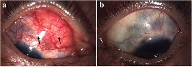 Image result for lesion sclera