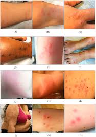 Image result for Cimex lectularius bites