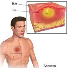The medical team at estetik we're superb. Abscess Wikipedia