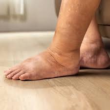 Image result for Edema