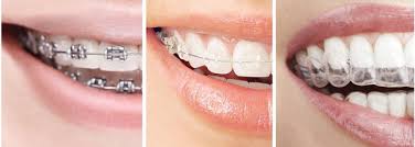 Find out how much each package might cost. Invisalign In Brooklyn Ny Clear Invisible Braces For Teens Adults