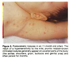 Image result for scabies on genitals