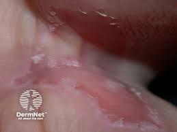 Image result for sore skin in the groin area