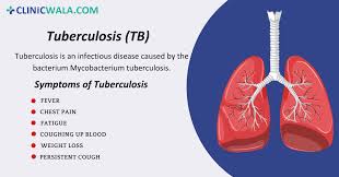 Image result for Tuberculosis