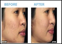 He said that i can return to work right away and the skin will slightly red. Acne Scar Treatment Beverly Hills Skin Rejuvenation Woodland Hills