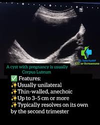 Image result for corpus luteum sonography)