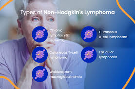Image result for Lymphoma
