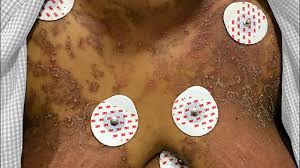 Image result for Pustular Psoriasis