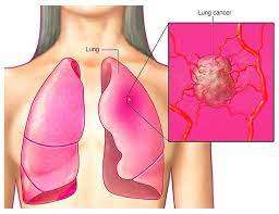 But if you suspect that some of the risk factors apply to you, then early screening may help people at high risk for the disease. What You Have To Know About Lung Cancer Cusabio