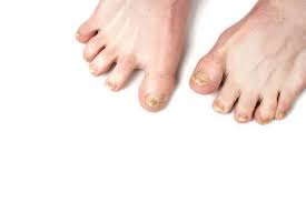 Neglesvamp Ben Sygdom Svampeinfektion Negle Ben Finger Med Onychomycose  Skader — Stockfoto © leravalera89 #447157004