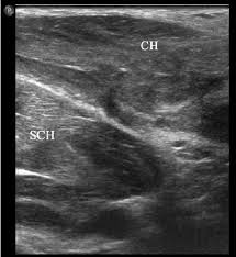Along with being considered a chest wall muscle, the levatores costarum muscles can also be grouped with the deepest muscles of the back , together with the interspinales. A 27 Year Old Male Elite Boxer Presenting With Pectoralis Muscle Download Scientific Diagram