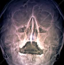 Image result for Sinus X Ray