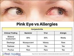 Image result for Allergic Conjunctivitis