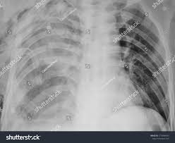 Image result for Flail Chest